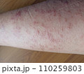 rash eczema dermatitis  on leg. inflammation of skin 110259803