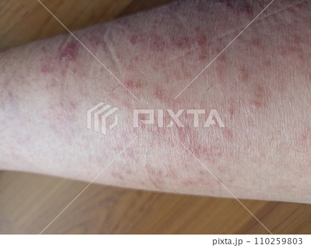 rash eczema dermatitis on leg. inflammation of skin rash eczema dermatitis on leg. inflammation of skin 110259803