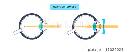 Normal eye and nearsightedness Normal eye and nearsightedness 110260234
