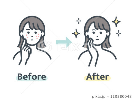 ニキビ解消前後 110280048