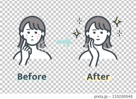ニキビ解消前後 110280048