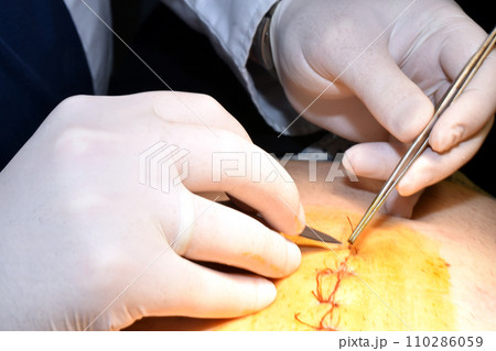The surgeon s hands at the moment of removing the suture threads on the patient s abdomen. The surgeon s hands at the moment of removing the suture threads on the patient s abdomen. 110286059