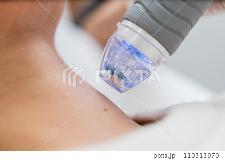Microneedle RF lifting procedure. close up Microneedle RF lifting procedure. close up 110313970