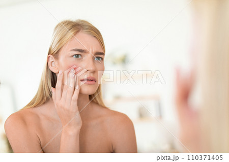 lady touching cheek unhappy about acne and skin imperfections indoors 110371405