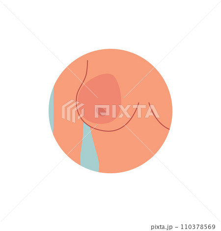 Breast reduction and correction plastic surgery, female breast with area marked vector illustration isolated on white Breast reduction and correction plastic surgery, female breast with area marked vector illustration isolated on white 110378569