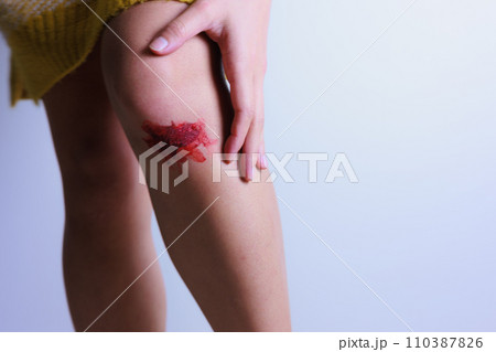 擦りむいた脚を抑える女性の手（ダーク） 110387826