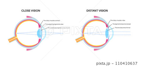 Eye accommodation poster Eye accommodation poster 110410637