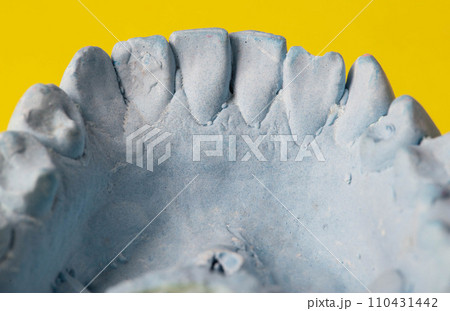 Blue plaster impression of a patient's dental jaw with crooked teeth and malocclusions on a yellow background. Manufacturing of braces to correct bite. View from above. Copy space for text 110431442