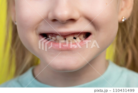 Smiling mouth of a girl with uneven growing molars and baby teeth. Pediatric dentistry, close-up. Malocclusion in children. Aesthetic dental restoration Smiling mouth of a girl with uneven growing molars and baby teeth. Pediatric dentistry, close-up. Malocclusion in children. Aesthetic dental restoration 110431499
