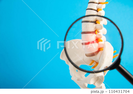 Model of the lumbar spine with a red intervertebral hernia and protrusion on a blue background under a magnifying glass. Concept of osteochodrosis and spondyloarthrosis and spinal arthritis. Copy 110431704