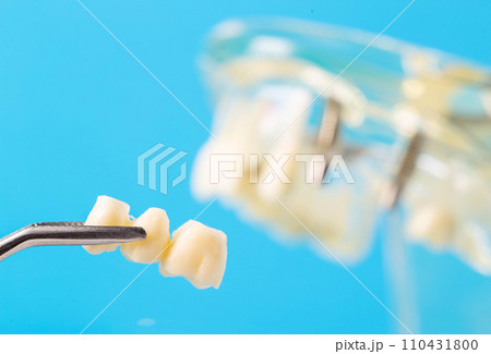 Dental bridge in tweezers against the background of a medical model of the dental jaw, close-up. Dental prosthetics in orthodontics and dentistry. Modern technology. Copy space for text 110431800