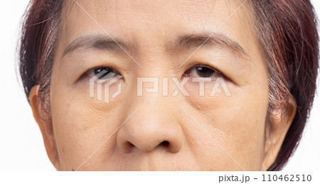 The ptosis or droopy eyelids in asian senior woman. 110462510