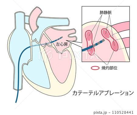 心房細動治療のカテーテルアブレーションのイラスト 110528441