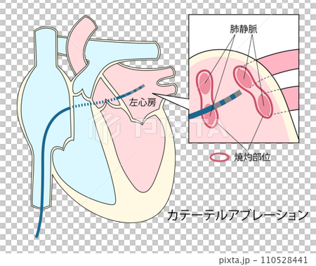 Illustration of catheter ablation for atrial fibrillation treatment 110528441