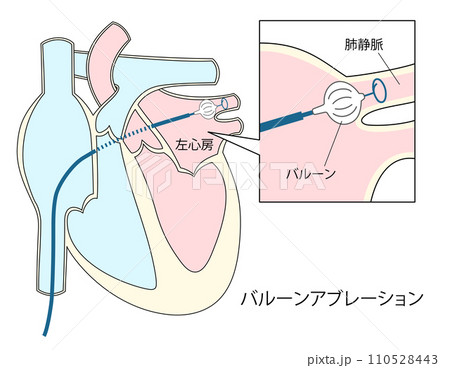 心房細動治療のバルーンアブレーションのイラスト 心房細動治療のバルーンアブレーションのイラスト 110528443