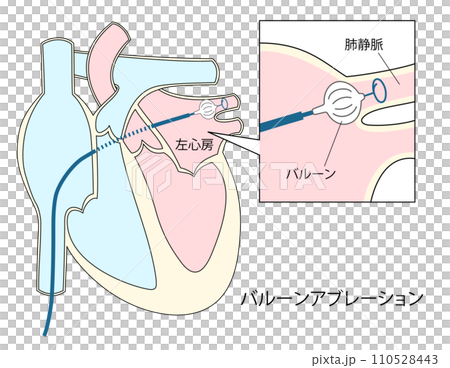 心房細動治療のバルーンアブレーションのイラスト 心房細動治療のバルーンアブレーションのイラスト 110528443