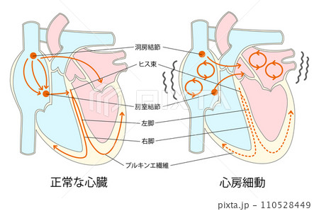 正常な心臓と心房細動の比較イラスト 110528449