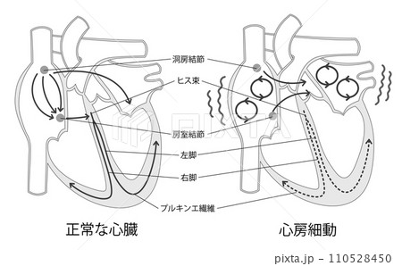 正常な心臓と心房細動の比較イラスト白黒 110528450