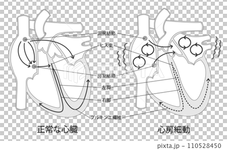 正常な心臓と心房細動の比較イラスト白黒 110528450