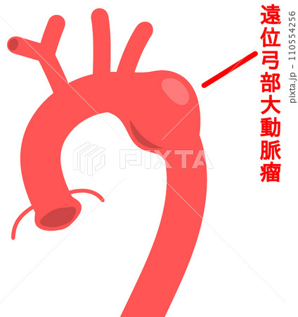 遠位弓部大動脈瘤 遠位弓部大動脈瘤 110554256