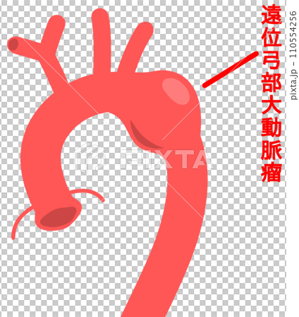遠位弓部大動脈瘤 遠位弓部大動脈瘤 110554256