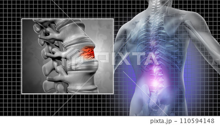 Spinal Fracture 110594148