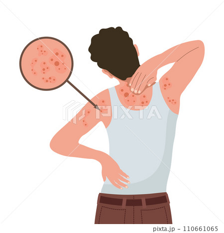 Allergic itching, skin inflammation, redness and irritation. Atopic dermatitis, eczema, psoriasis. Healthcare and medicine. Vector 110661065