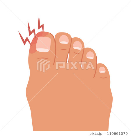 Swollen toe, onychocryptosis. Foot with nail disease or infection. Foot with onychomycosis or nail fungus. Healthcare and medicine. Vector Swollen toe, onychocryptosis. Foot with nail disease or infection. Foot with onychomycosis or nail fungus. Healthcare and medicine. Vector 110661079