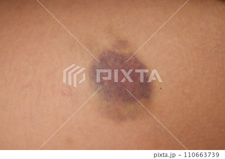 Accidents and wounds caused by impact. Purple skin bruises and abrasions. Accidents and wounds caused by impact. Purple skin bruises and abrasions. 110663739