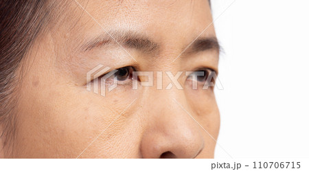 The ptosis or droopy eyelids in asian senior woman. The ptosis or droopy eyelids in asian senior woman. 110706715