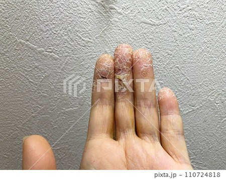 アトピー性皮膚炎患者、ペットアレルギーと汗疱疹の悪化による皮膚の裂け、手湿疹・手荒れ、自己免疫疾患 110724818