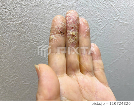 アトピー性皮膚炎患者、ペットアレルギーと汗疱疹の悪化による皮膚の裂け、手湿疹・手荒れ、自己免疫疾患 アトピー性皮膚炎患者、ペットアレルギーと汗疱疹の悪化による皮膚の裂け、手湿疹・手荒れ、自己免疫疾患 110724820