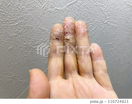 アトピー性皮膚炎患者、ペットアレルギーと汗疱疹の悪化による皮膚の裂け、手湿疹・手荒れ、自己免疫疾患 110724821