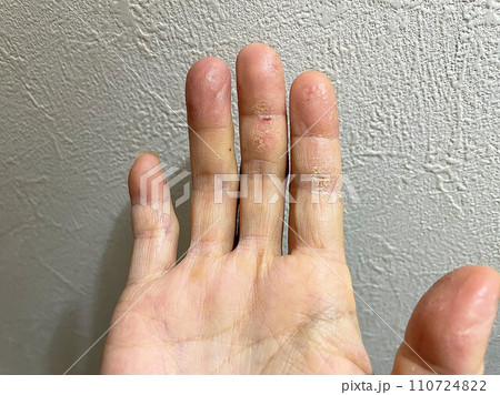 アトピー性皮膚炎患者、ペットアレルギーと汗疱疹の悪化による皮膚の裂け、手湿疹・手荒れ、自己免疫疾患 110724822