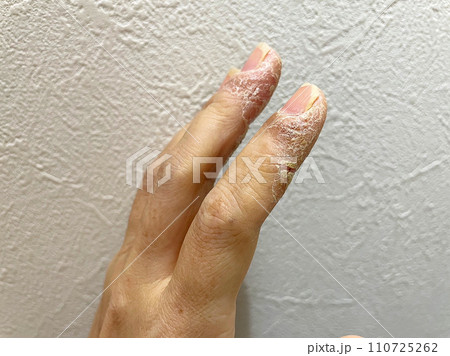 アトピー性皮膚炎患者の手湿疹、汗疱疹の鱗屑、ひょう疽、細菌性爪囲炎、異汗性湿疹、 110725262