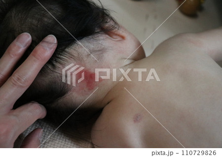 ウンナ母斑、赤ちゃん、皮膚病、赤、あざ、血管腫 ウンナ母斑、赤ちゃん、皮膚病、赤、あざ、血管腫 110729826