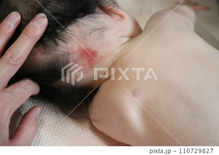 ウンナ母斑、赤ちゃん、皮膚病、赤、あざ、血管腫 ウンナ母斑、赤ちゃん、皮膚病、赤、あざ、血管腫 110729827