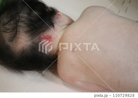 ウンナ母斑、赤ちゃん、皮膚病、赤、あざ、血管腫 110729828