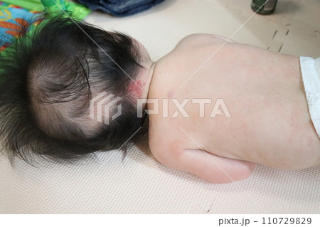 ウンナ母斑、赤ちゃん、皮膚病、赤、あざ、血管腫 110729829