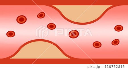 つまり気味の血管 110732813