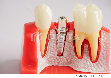 Dental implant, artificial tooth roots into jaw, root canal of dental treatment, gum disease, teeth model for dentist studying about dentistry. Dental implant, artificial tooth roots into jaw, root canal of dental treatment, gum disease, teeth model for dentist studying about dentistry. 110734892