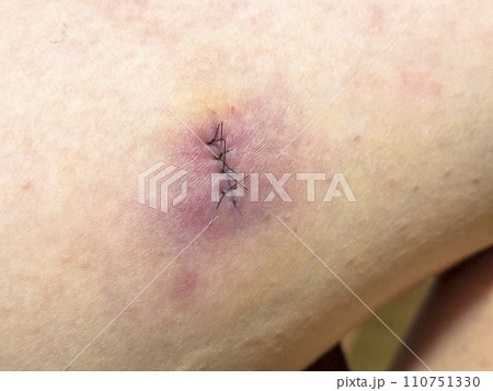 外科手術 縫合 110751330