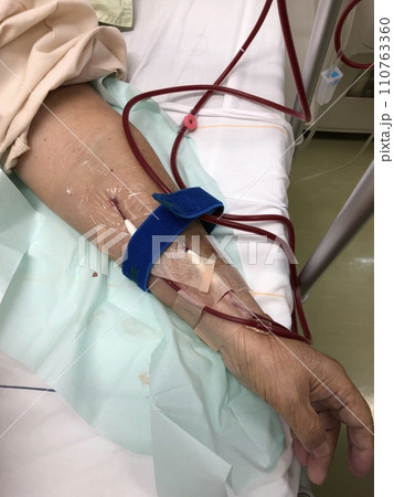 人工透析治療の様子 110763360