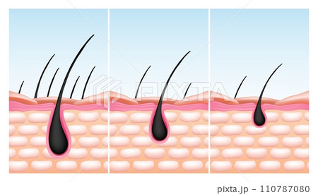 Scalp skin. Hair root reduce. Bulb or follicle fall. Baldness and growth structure. Nutrition drops treatment. Grow process. Epidermis and dermis microscopic diagram. Vector infographics Scalp skin. Hair root reduce. Bulb or follicle fall. Baldness and growth structure. Nutrition drops treatment. Grow process. Epidermis and dermis microscopic diagram. Vector infographics 110787080