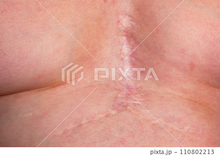 A young caucasian man with a scar on his chest due to a heart surgery. Concept of personal improvement. A young caucasian man with a scar on his chest due to a heart surgery. Concept of personal improvement. 110802213