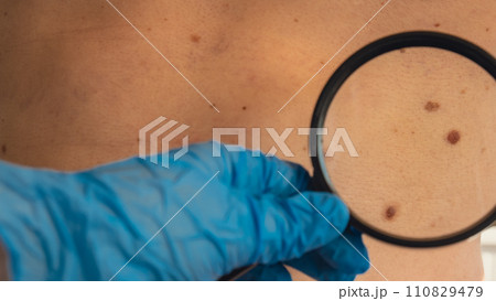 Mole dermoscopy, preventive of melanoma. Dermatologist examining patient's birthmark with magnifying glass in clinic. Checking benign moles. Skin abnormalities care Mole dermoscopy, preventive of melanoma. Dermatologist examining patient's birthmark with magnifying glass in clinic. Checking benign moles. Skin abnormalities care 110829479