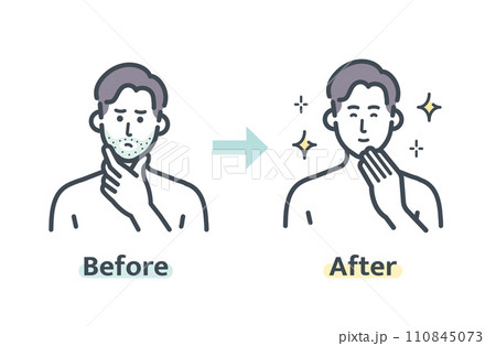 ヒゲ脱毛のビフォーアフター ヒゲ脱毛のビフォーアフター 110845073