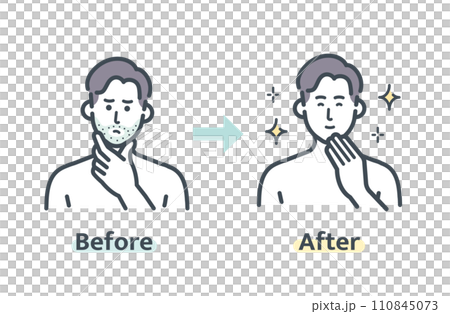 ヒゲ脱毛のビフォーアフター ヒゲ脱毛のビフォーアフター 110845073