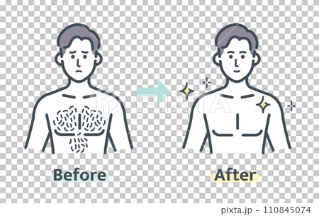 胸毛除毛前後 胸毛除毛前後 110845074