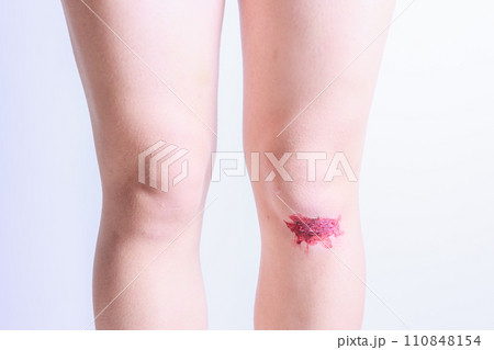擦りむいて血が出ている女性の脚 擦りむいて血が出ている女性の脚 110848154